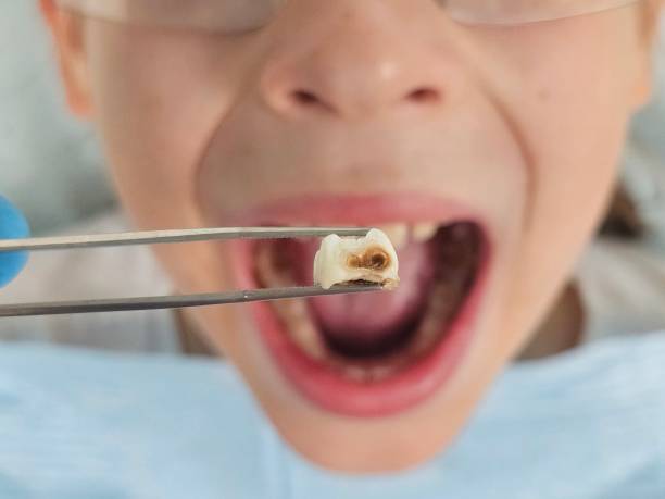 Best Emergency Root Canal Therapy in Fivepointville, PA